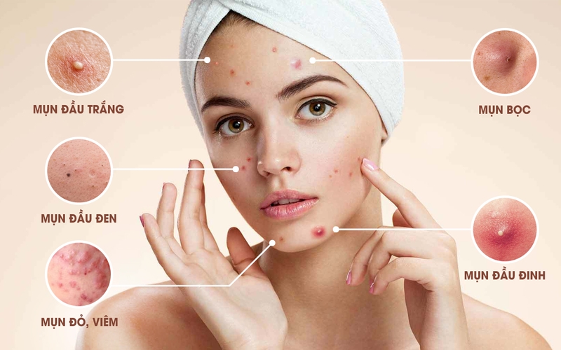 Quy trình chăm sóc da mụn chuẩn khoa học cho tuổi dậy thì
