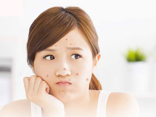Nguyên nhân gây mụn ở tuổi dậy thì