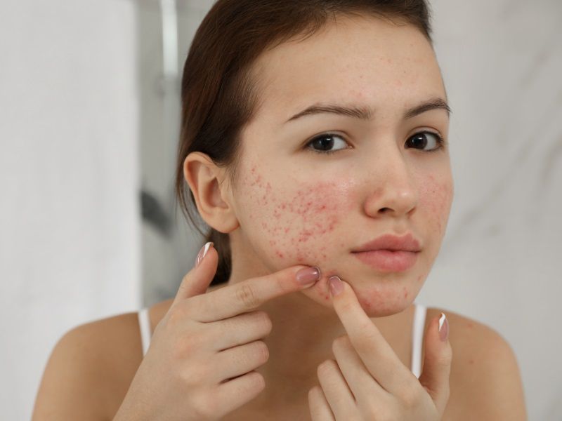 Quy trình các bước phục hồi da bị kích ứng chuẩn y khoa