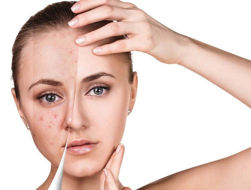 Quy trình chuẩn y khoa: Cách chăm sóc da bị mụn đúng cách hàng ngày