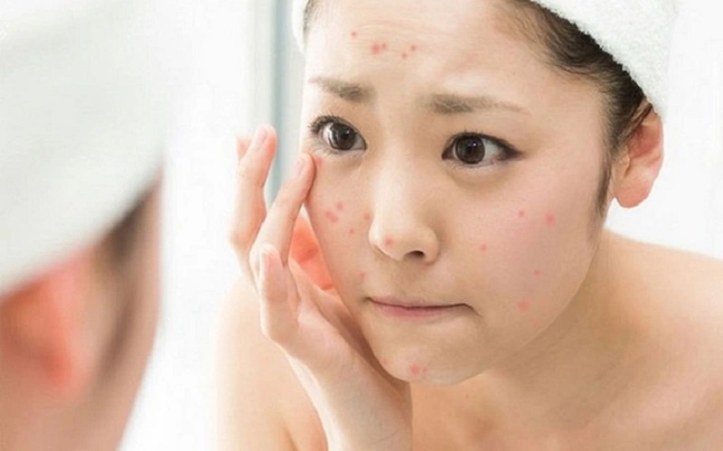 Nguyên nhân gây mụn và cơ chế hình thành thâm sẹo trên da