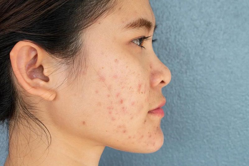 Tìm hiểu nguyên nhân khiến da bị thâm sau mụn