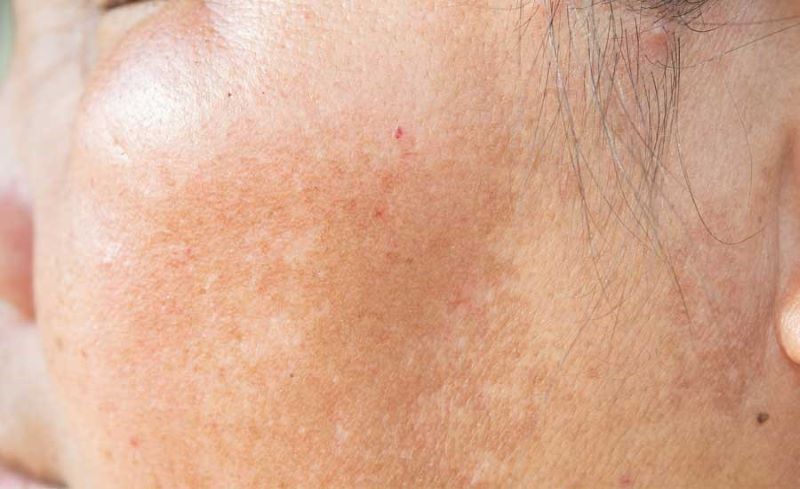 Hướng dẫn cách làm sáng vùng da bị thâm an toàn tại nhà