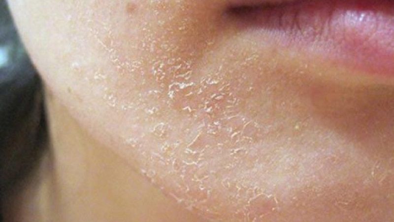 Các bước dưỡng da chuẩn cho làn da đang tróc vảy