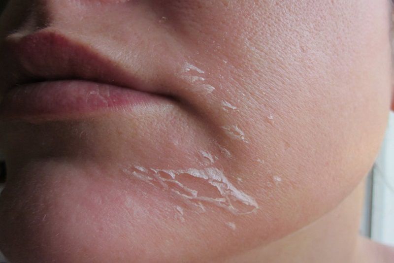 Nguyên nhân khiến làn da tổn thương và bong tróc