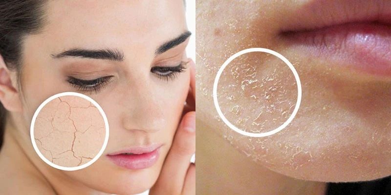 Da bị bong tróc nên chăm sóc thế nào để phục hồi an toàn?