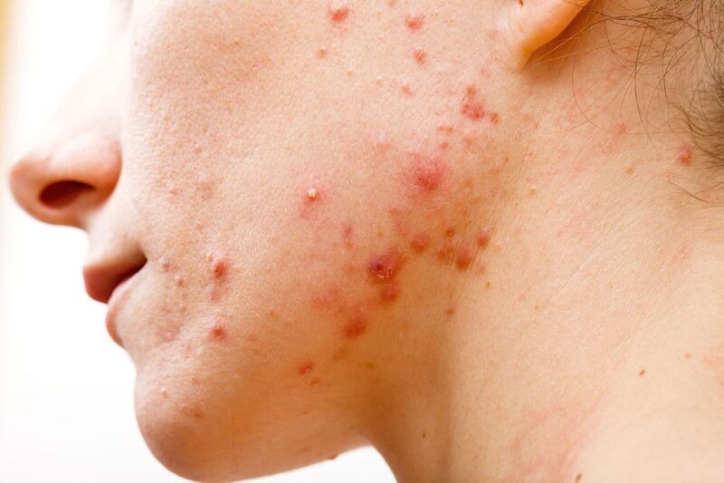 Cách phòng ngừa mụn hiệu quả giúp duy trì làn da khỏe đẹp