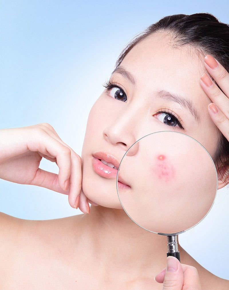 Điểm danh các nguyên nhân gây mụn hàng đầu hiện nay