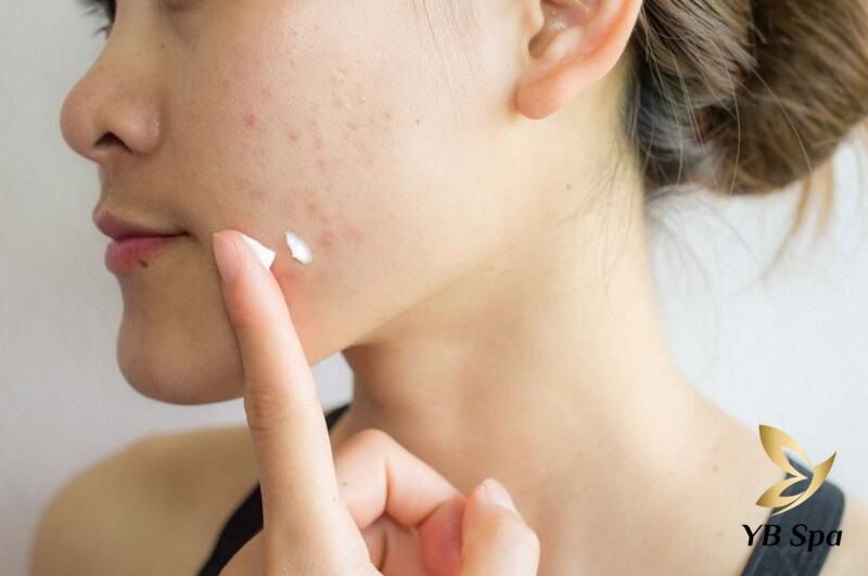 Những sai lầm kinh điển cần tránh để không bị thâm sẹo