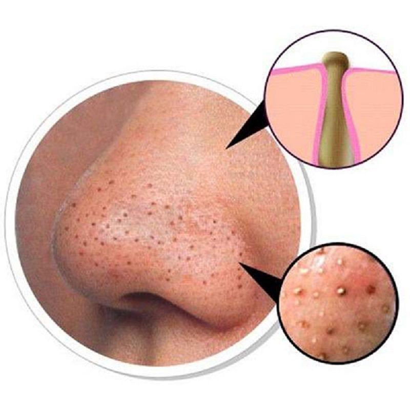 Bản chất của mụn đầu đen và nguyên nhân tái phát liên tục