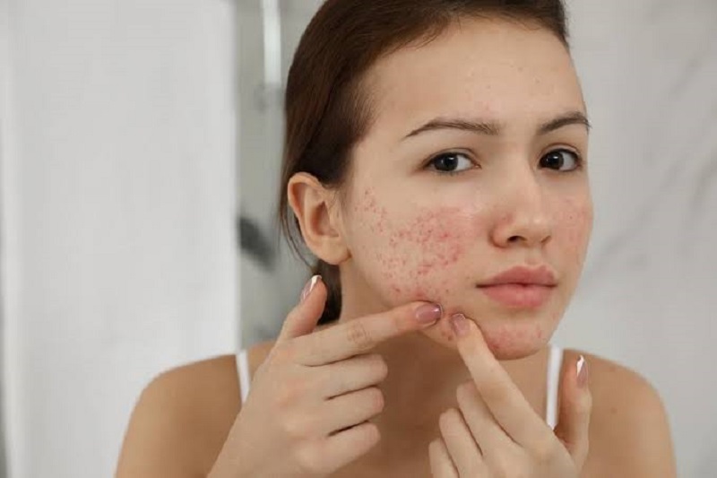 Nguyên tắc vàng trong cách chăm sóc da bị mụn đúng cách