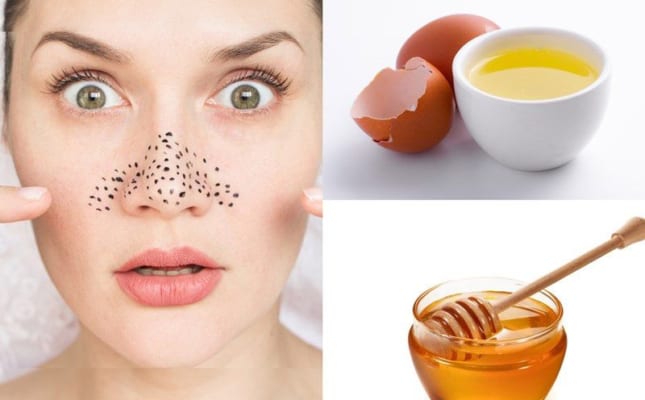 Các phương pháp xử lý mụn đầu đen chuẩn khoa học